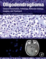 Oligodendrogliomas: Pathology, Molecular Biology, Imaging, and Research Techniques