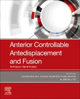 Anterior Controllable Antedisplacement and Fusion (ACAF): Technique in Spinal Surgery