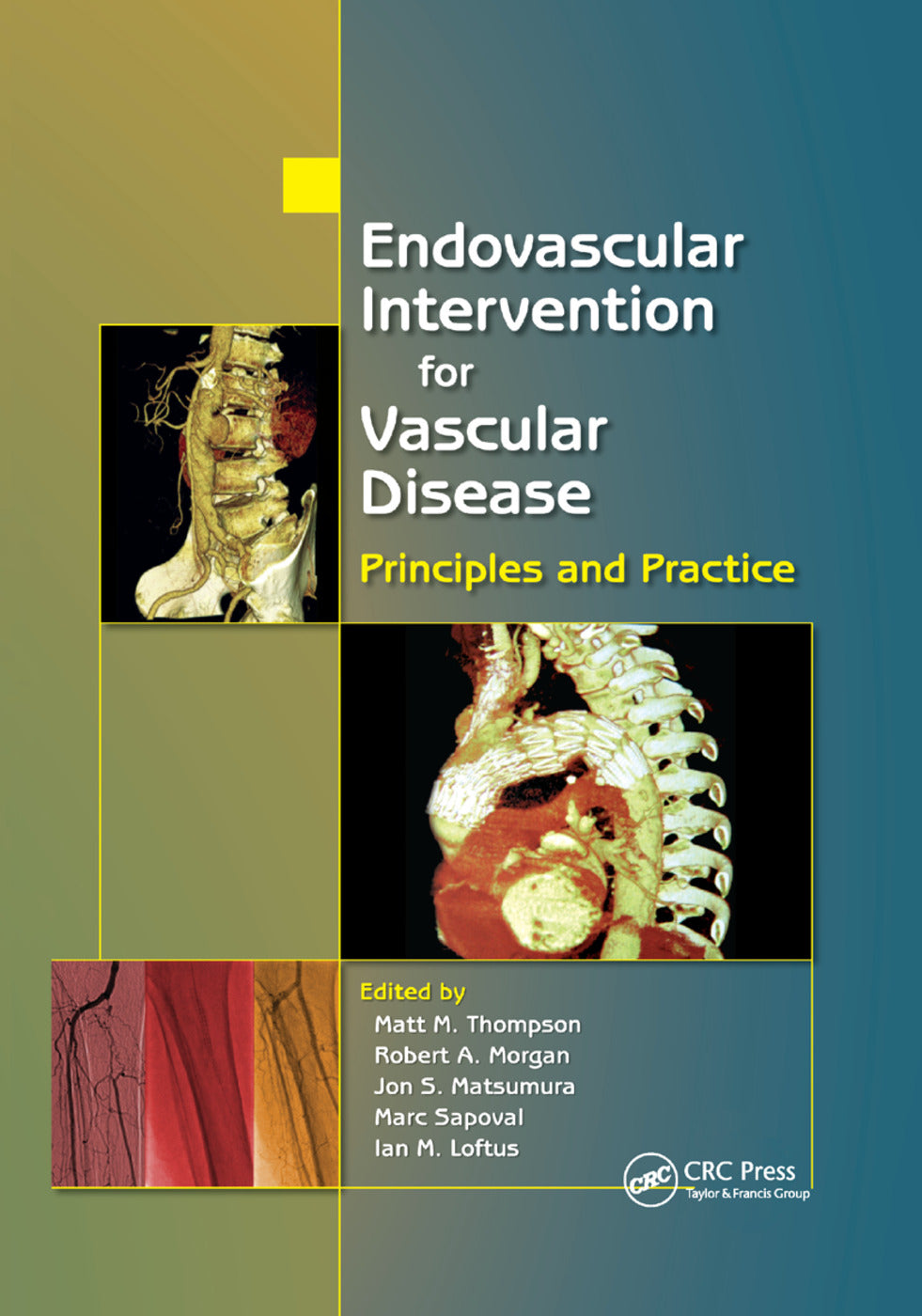 Endovascular Intervention for Vascular Disease