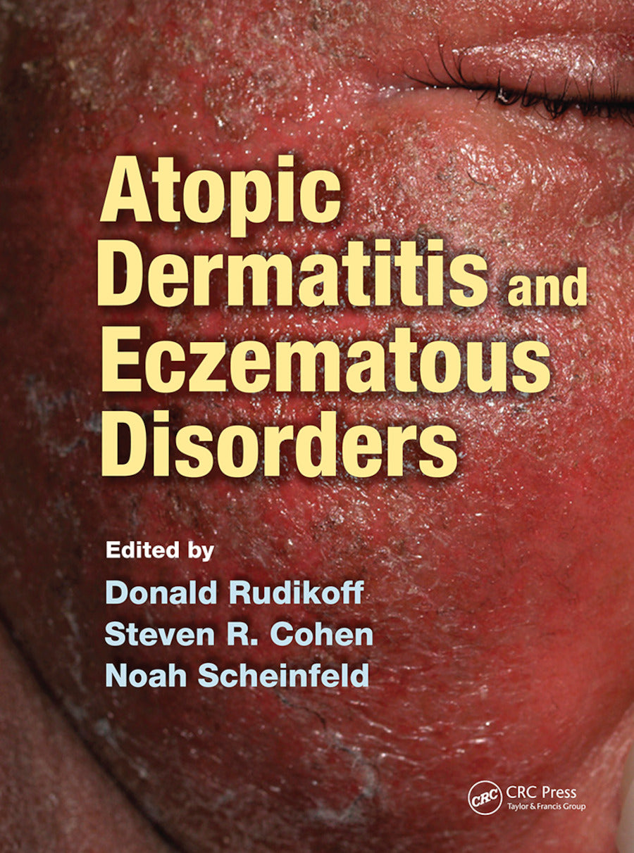 Atopic Dermatitis and Eczematous Disorders