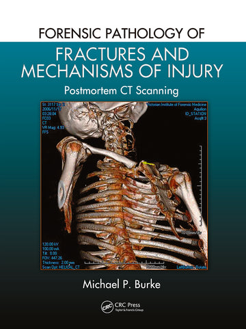 Forensic Pathology of Fractures and Mechanisms of Injury