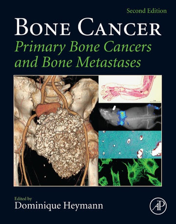 Bone Cancer 2E