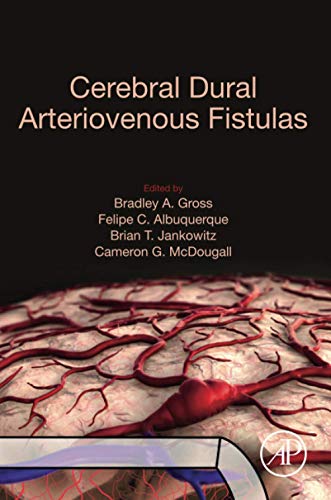 Cerebral Dural Arteriovenous Fistulas: Features, Mechanisms, and Management